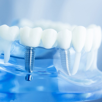 Dental Implant $1500