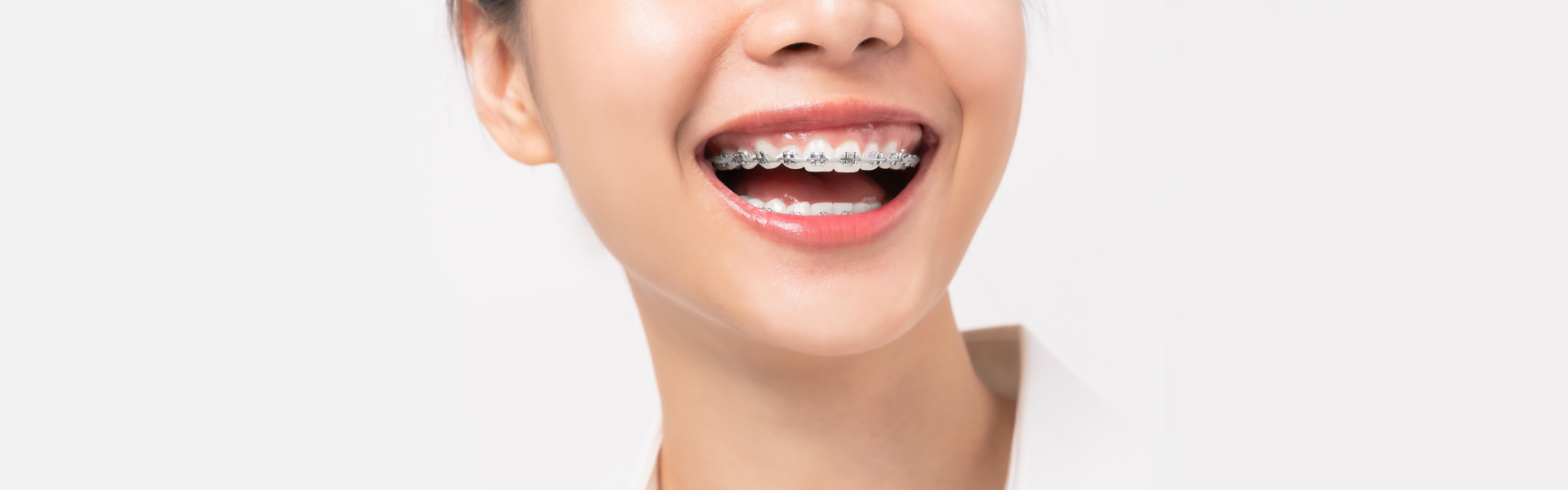 Clear Braces Excellent Alternative Than Metal Braces To Correct Orthodontic Problems
