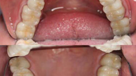 image of after results of broken old crowns and fillings
