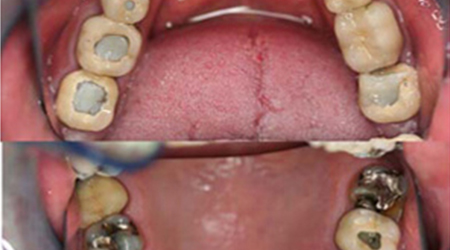 image of before result of broken old crowns and fillings