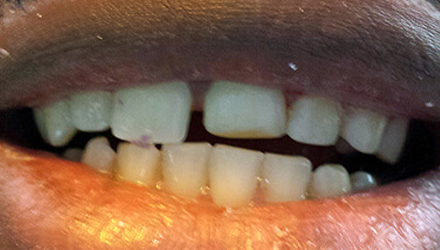 before image of broken tooth treatments