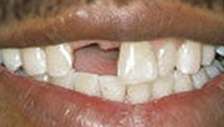 before image of dental bridges treatments