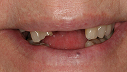 before image of dental crowns and bridges treatments