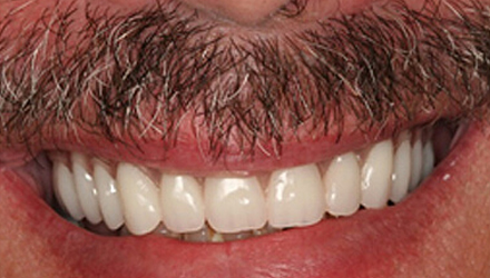 after image of infected teeth and gum treatment