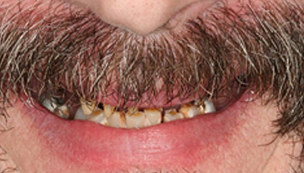 before image of infected teeth and gum treatment