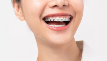 Frenos transparentes excelente alternativa a los frenillos metálicos para corregir problemas de ortodoncia