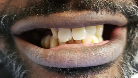 before image of infected teeth and gum treatment