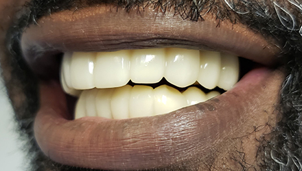 after image of infected teeth and gum treatment
