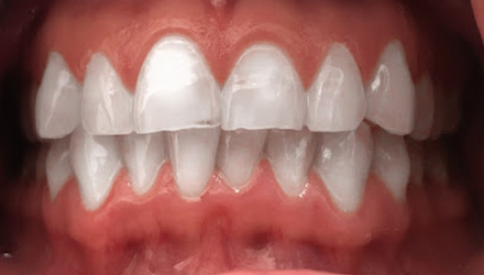 after image of infected teeth and gum treatment