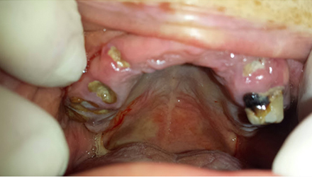 before image of infected teeth and gum treatment