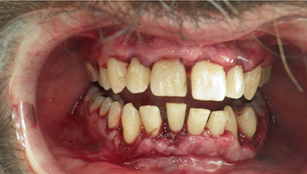 before image of infected teeth and gum treatment