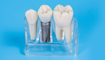 How to Find the Best Dental Implant Clinic Near Me?
