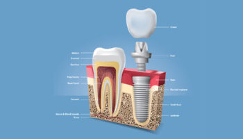 Dental Implants: What Are the Main 3 Types of Dental Implants?