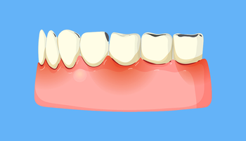 What Happens If You Don’t Remove an Infected Tooth?