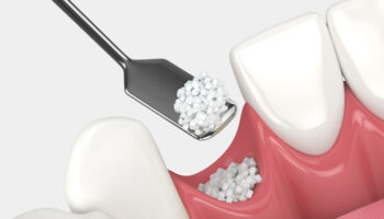 Do You Need Bone Grafting? Signs Your Jawbone May Require Support