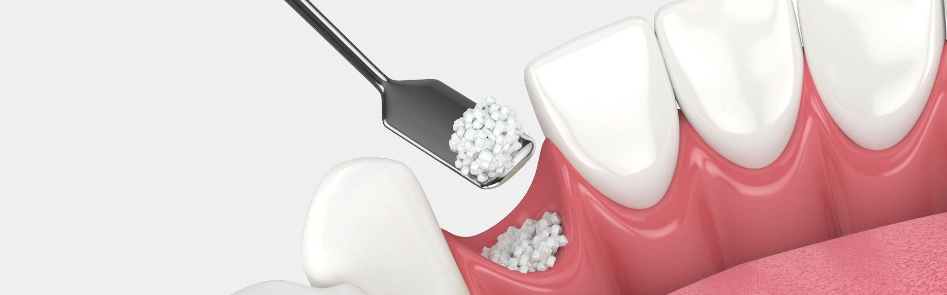 Do You Need Bone Grafting? Signs Your Jawbone May Require Support