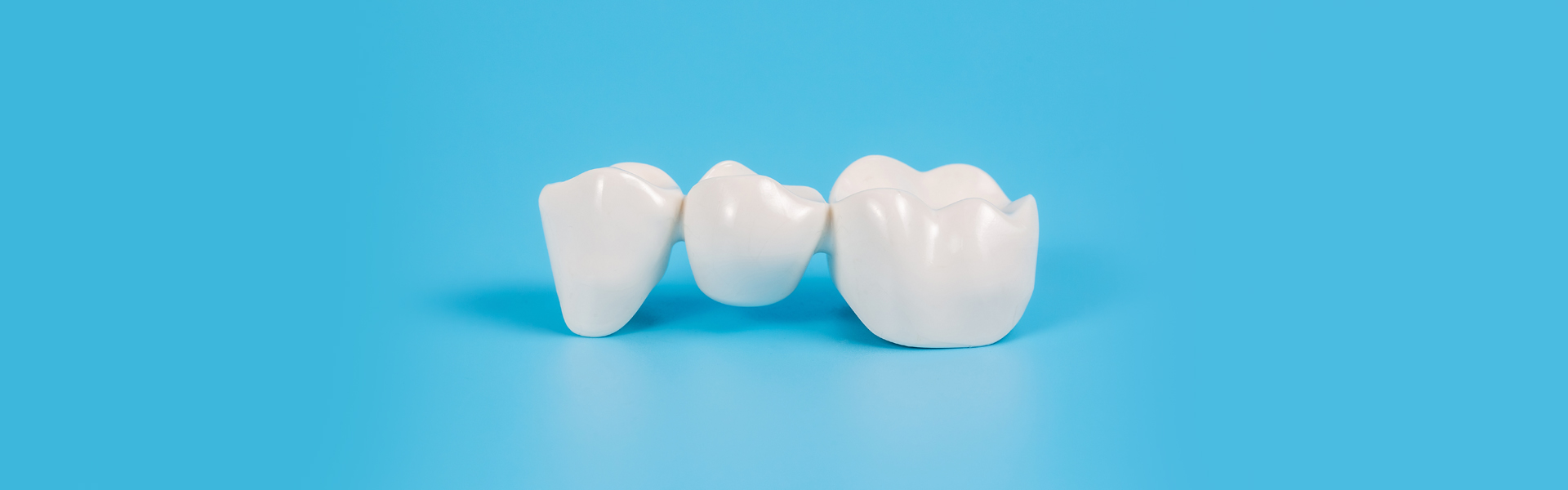 How Dental Bridges Prevent Oral Health Issues After Tooth Loss?
